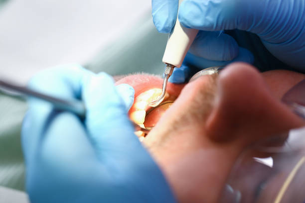 Best Emergency Dentist for Knocked-Out Tooth in Montgomery, AL